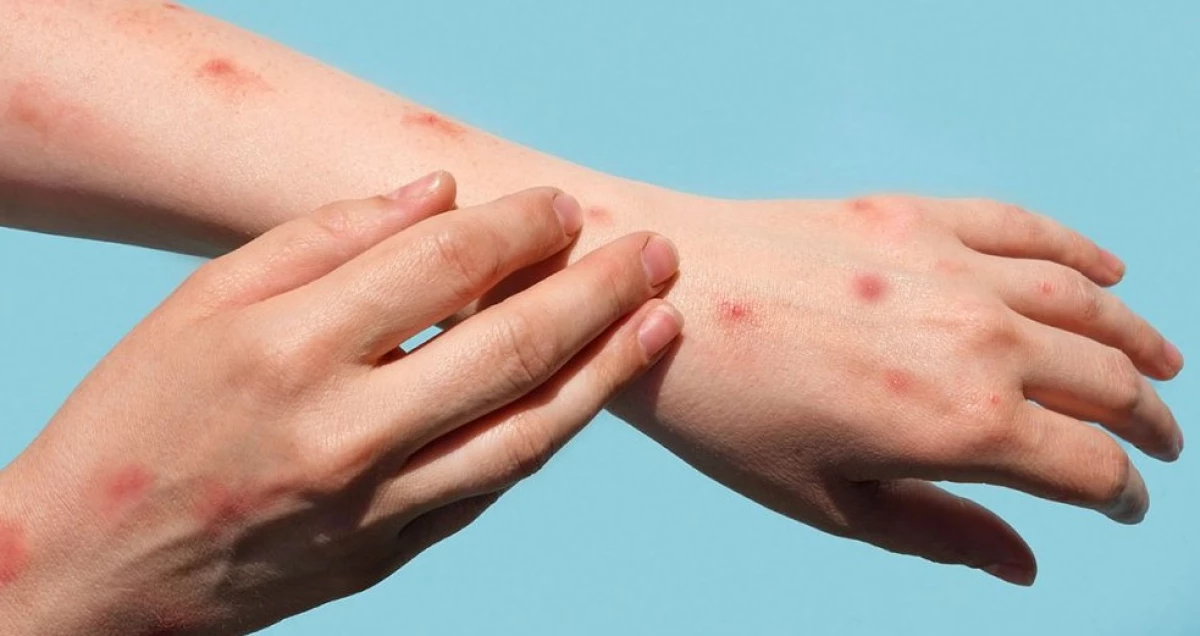 Kasus Mpox Sudah Menyebar Luas, Perhatikan Perbedaannya dengan Cacar Biasa