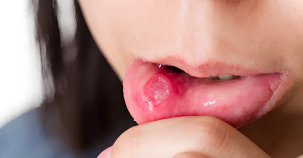 5 Penyebab Sariawan di Bibir yang Harus Kamu Tahu